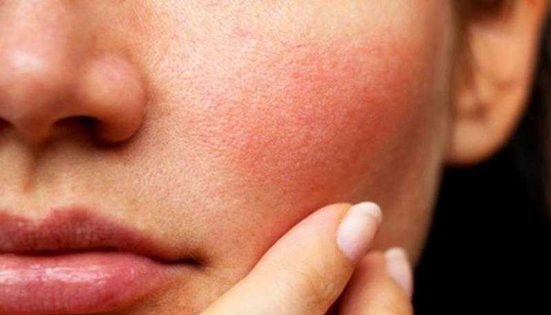 9 طرق العناية بالبشرة الحساسة