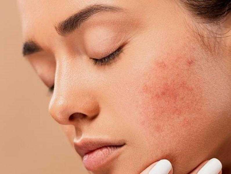 أهم طرق لعلاج ندوب الوجة
