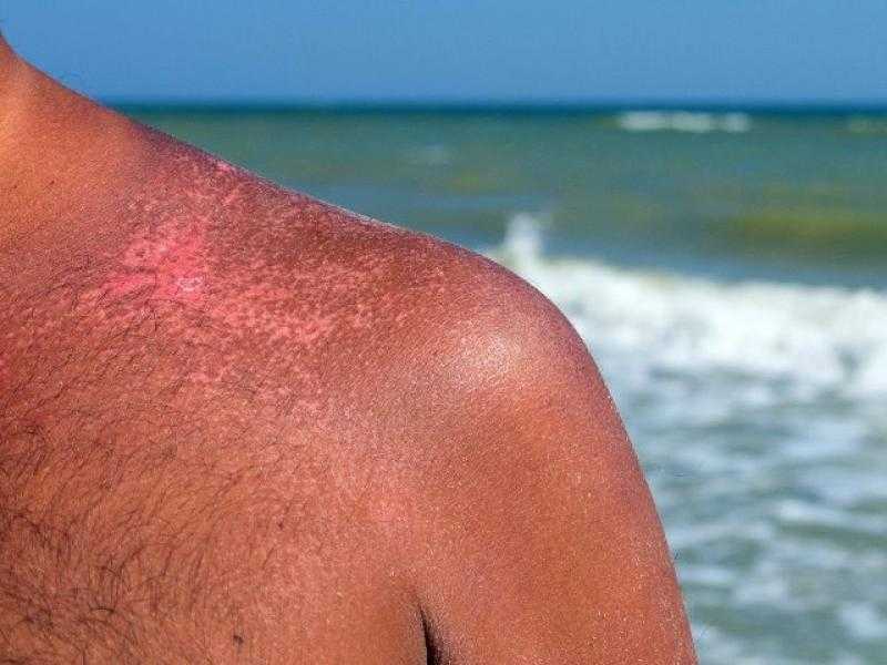 كيف يتم علاج حروق الشمس