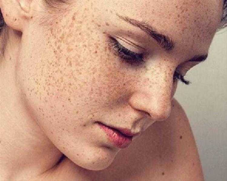 كيف تواجه البقع الصبغية الناجمة عن الأشعة فوق البنفسجية؟