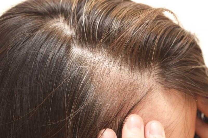 هاني الناظر يكشف أفضل الزيوت الطبيعية لعلاج تساقط الشعر