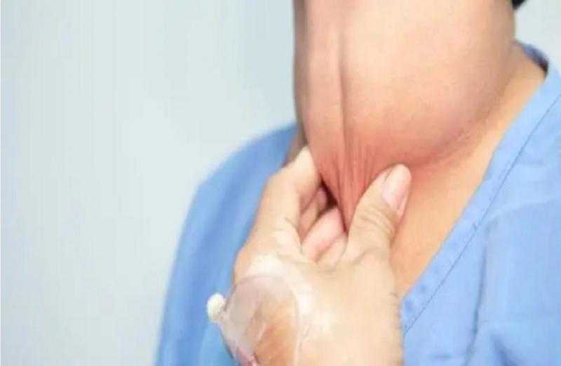 أسباب الأنيميا وعلاقتها بالغدة الدرقية.. حسام موافي يُوضح