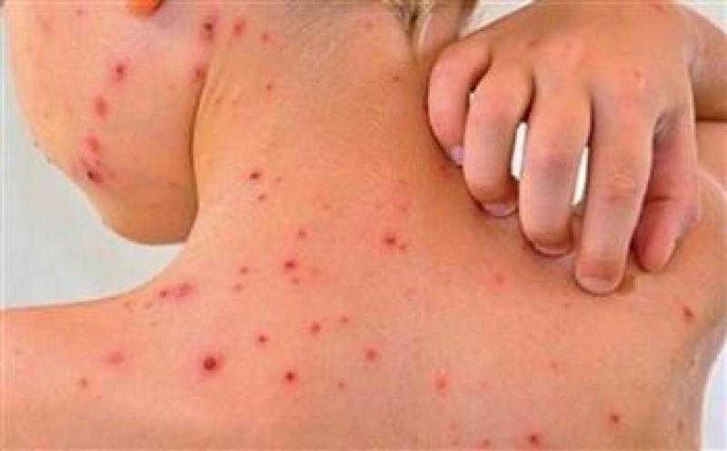بنجلادش تسجل ألف وفاة بحمى الضنك منذ بداية العام