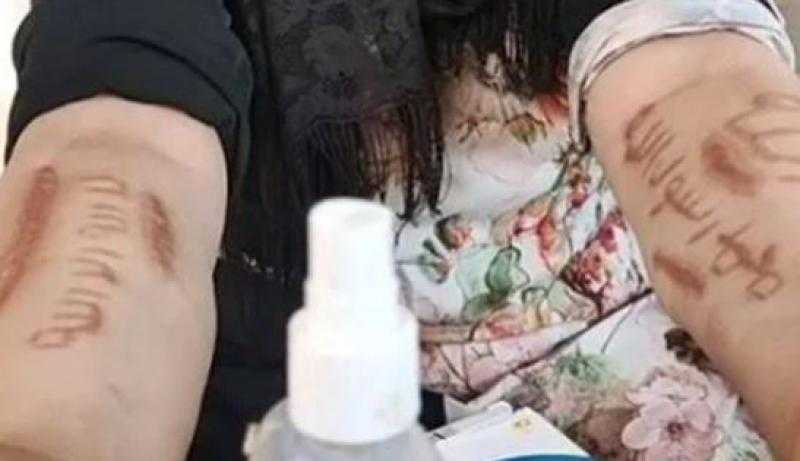 سيدة بالغربية تروي كواليس مرعبة عن إصابتها بجروح قطعية غير معلوم سببها