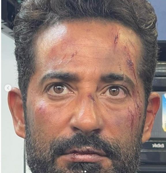 بإصابات متعددة بالوجه.. عمرو سعد يشارك الجمهور بصور من كواليس فيلم الغربان