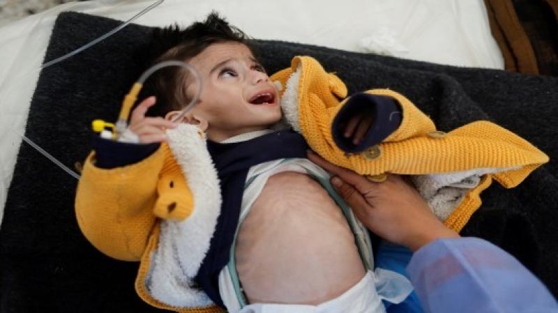 صحة غزة: ارتفاع حصيلة ضحايا سوء التغذية والجفاف إلى 18 شهيدا