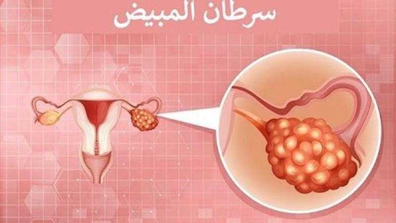 دراسة تكشف العلاقة بين الأرق وسرطان المبيض