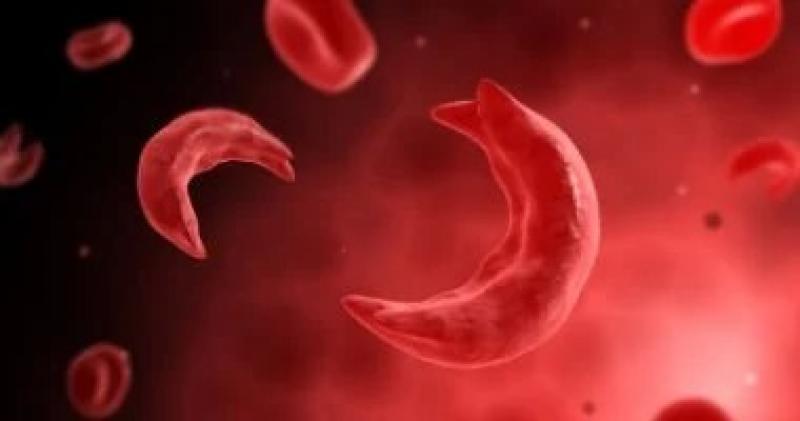 اليوم العالمى لـ الأنيميا المنجلية.. 4 علامات تدل على الإصابة بالمرض