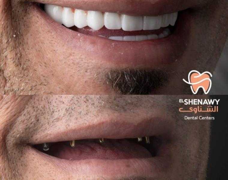 ما هو تركيب الأسنان الزيركون ومميزاتها واسعارها