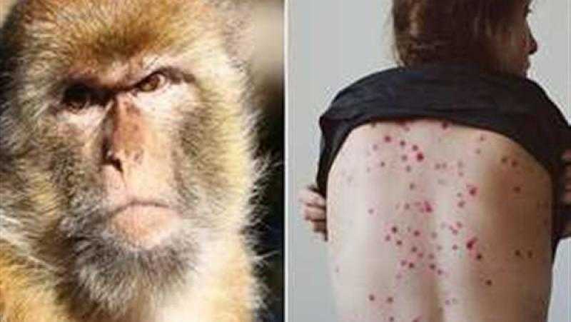 مفاجأة مدوية.. لقاح موجود يعالج جدري القرود بدون مخاطر