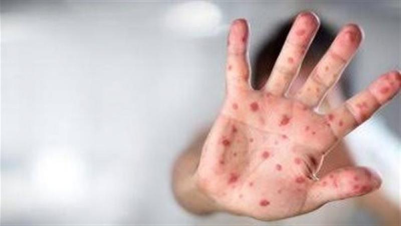 استشاري: جدري القرود تسميته خاطئة والأصح نسبته للقوارض