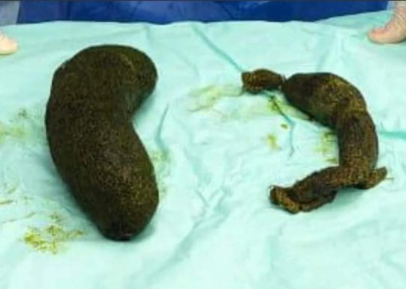 فتاة تأكل شعرها.. مستشفى المنصورة التخصصي تستقبل حالة نادرة