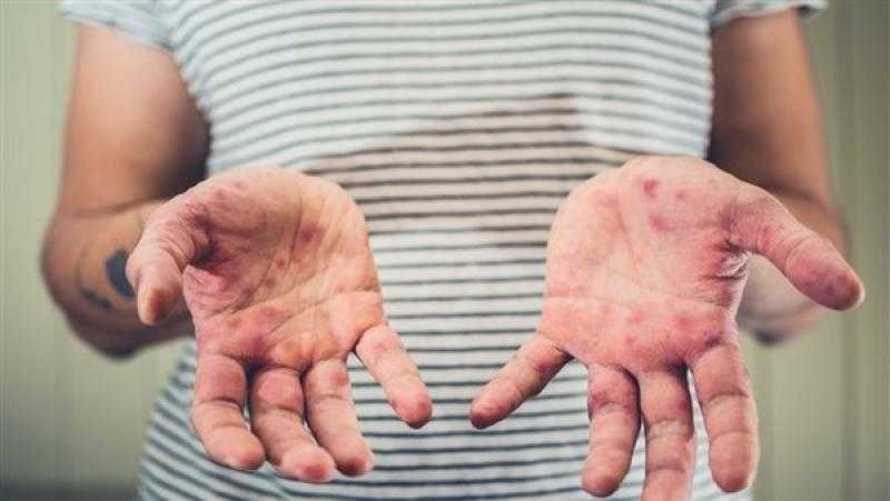 الجمعية المصرية للحساسية والمناعة: سلالة جدري القرود المتواجدة حاليا نسبة الوفيات فيها 3%