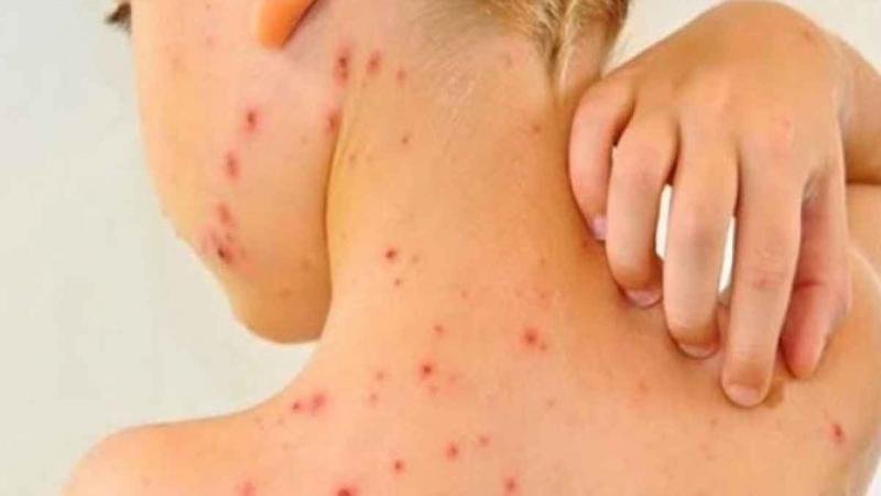 الصحة العالمية: أعراض جدرى القرود تستمر من 2 لـ 4 أسابيع وتختفى تلقائيا
