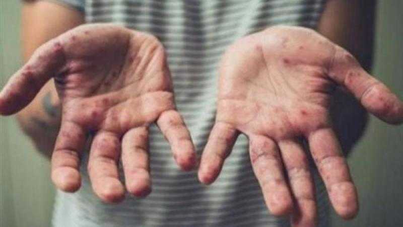 استشاري مناعة: جدري القرود ليس سريع الانتشار ومصر خالية من المرض حتى الآن