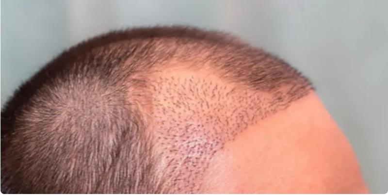 أحدث الطرق والتقنيات.. تعرف على أنواع عمليات زراعة الشعر