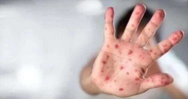 وزارة الصحة الأردنية تسجل إصابة بجدرى القرود لشخص غير أردنى مقيم فى البلاد