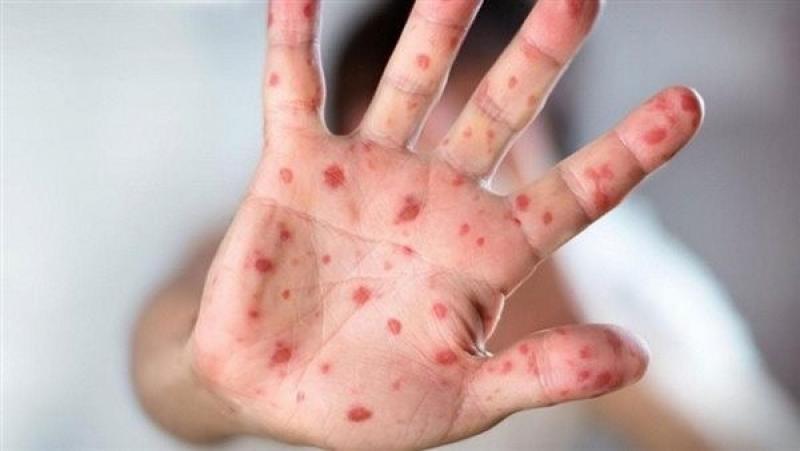 رئيس الرابطة الطبية الأوروبية: تاريخ ظهور جدري القرود يؤكد عدم تصنيعه معمليا