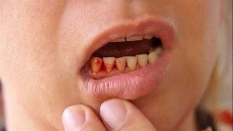 نصائح فعالة للحفاظ على صحة اللثة والوقاية من النزيف