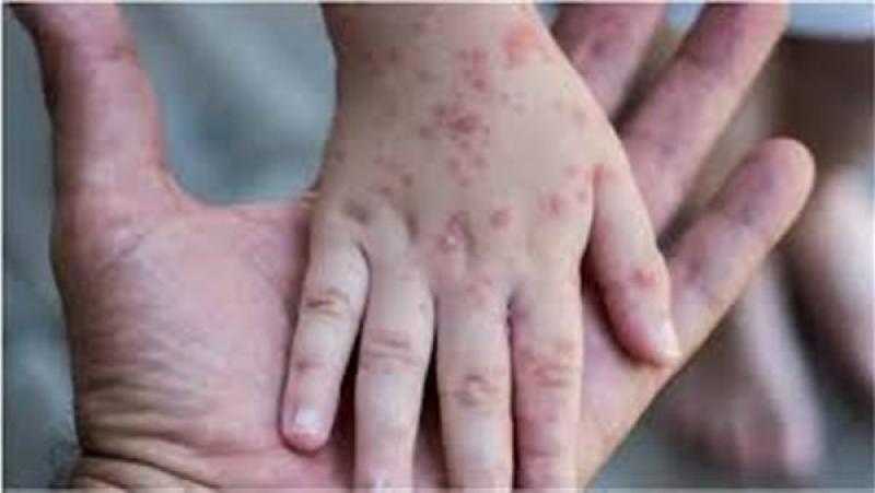 تسجيل أول إصابة بجدري القرود في كندا.. منظمة الصحة تحذر