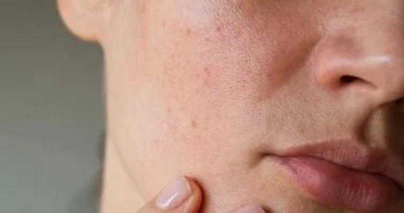 ‎وصفات طبيعية لعلاج مشكلة المسام المفتوحة
