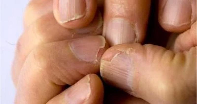 10 علامات تحذيرية على الأظافر تشير إلى الإصابة بأمراض مزمنة ومعدية
