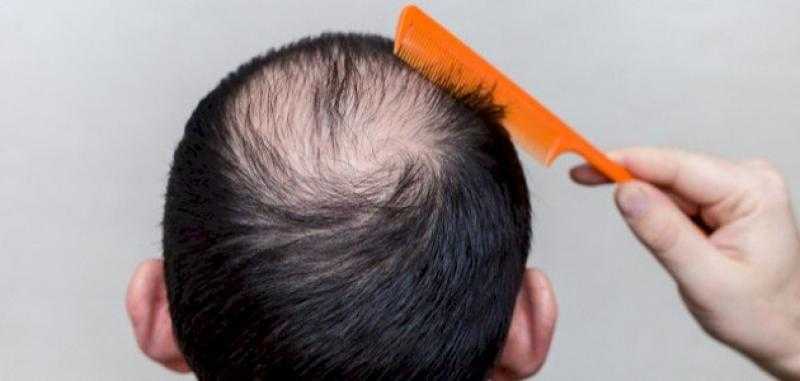 علماء يتوصلون إلى بروتين لعلاج تساقط الشعر.. ويكافح «الثعلبة»