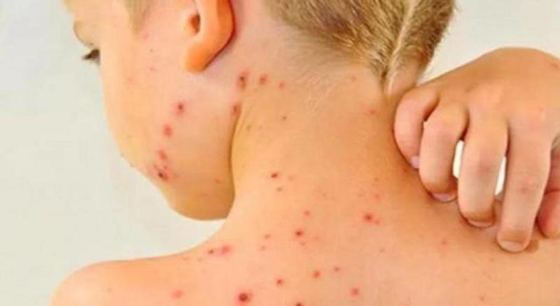 أمريكا: حالات الإصابة بمرض الحصبة تتجاوز 700 حالة في ست ولايات
