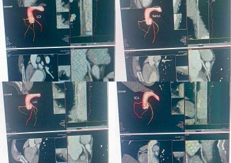 مستشفى منوف العام تسجل إنجازا طبيا بإجراء أول أشعة مقطعية للقلب دون تدخل جراحي