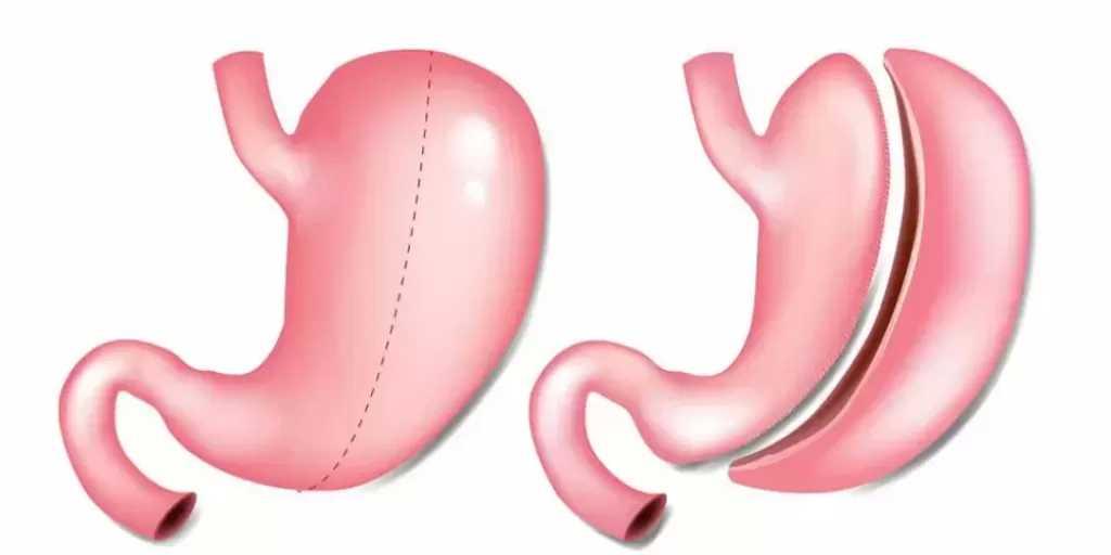 الدليل العملي لاتخاذ قرار عملية تكميم المعدة