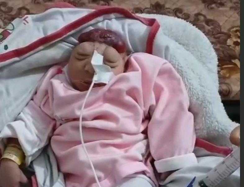 تزايد ظاهرة تشوه الأجنة في غزة.. ولادة طفلة “بلا دماغ” ومطالب بالتحقيق في أسلحة إسرائيل (فيديو)
