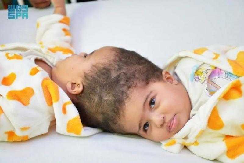 نجاح فصل التوأم الملتصق الإريتري “أسماء وسمية” بعد عملية جراحية استغرقت 15 ساعة ونصفًا بالرياض