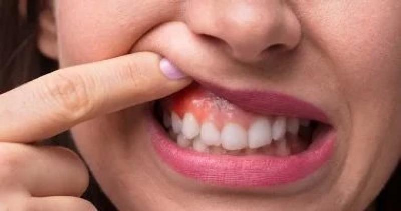 دراسة تربط بين نظافة الفم وخطر الإصابة بالسرطان.. نصائح للوقاية