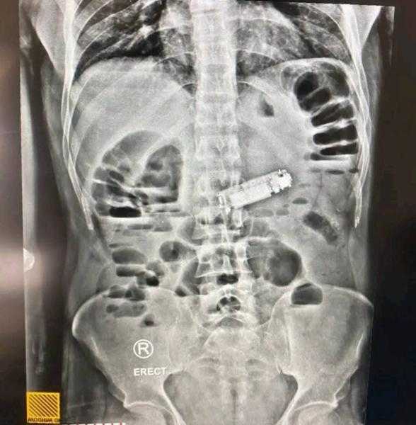 استخراج هاتف محمول من معدة مريض بمستشفى الغردقة العام