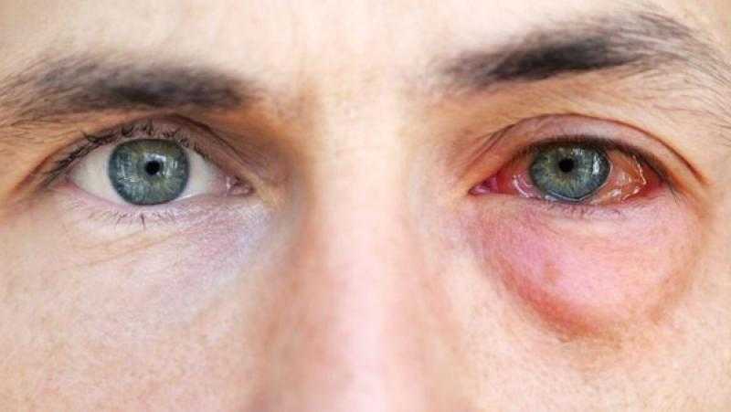 جفاف العين والحساسية الموسمية.. أبرز أمراض الشتاء