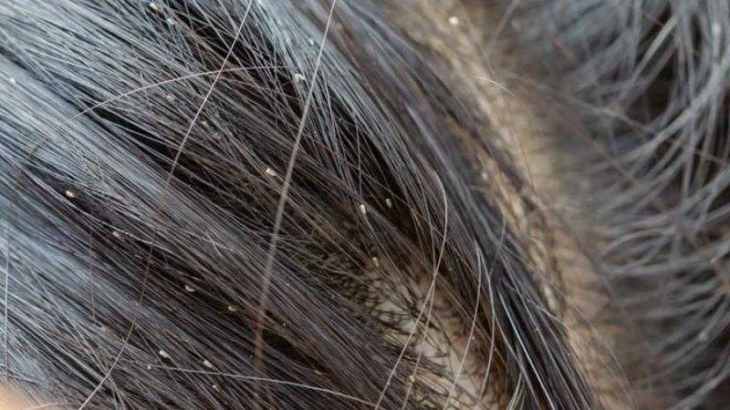 هيئة الدواء تحذر من عبوات مغشوشة لمستحضر لمكافحة القمل وعلاج الجرب