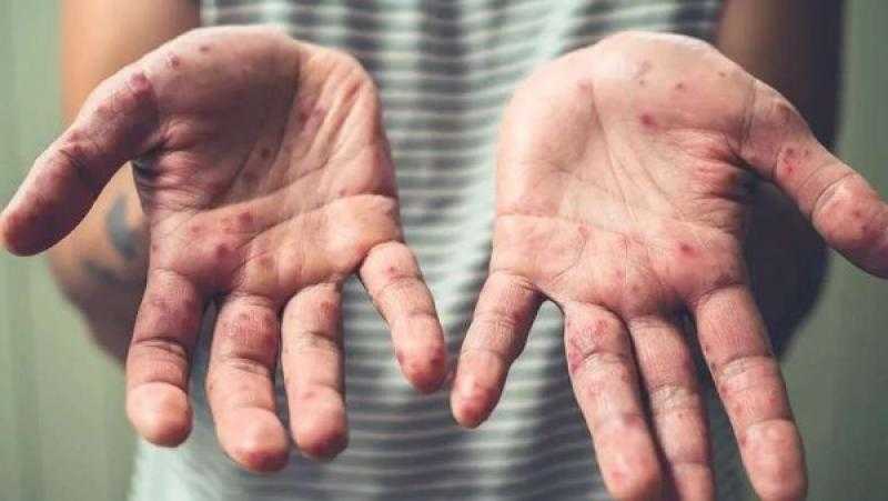 حقيقة انتشار فيروس HFMD في المدراس.. وزارة الصحة تكشف التفاصيل