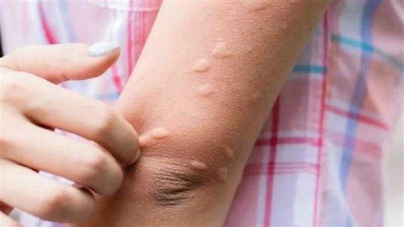 مجدي بدران: لا لقاح لحساسية البرد ويمكن الوقاية بالسلوكيات الصحية