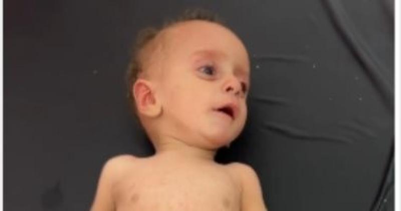 الرضيع الفلسطينى أنس أبو سعيد يسافر للعلاج فى إيطاليا