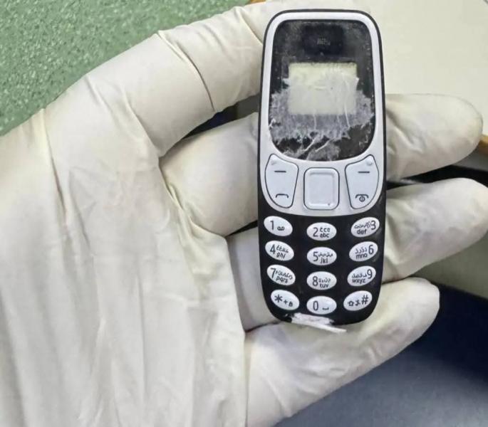 استخراج هاتف محمول من بطن مريض بعد 11 شهرا بمركز الجهاز الهضمي بالمنصورة