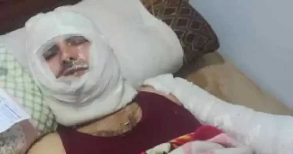 ضبط المتهمين بإشعال النيران فى شخص أمام زوجته وإصابته بحروق خطيرة