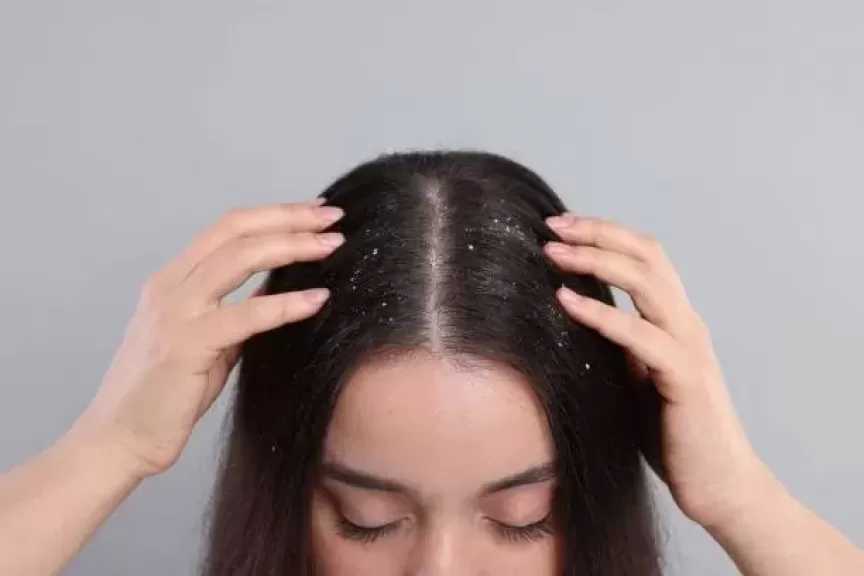 وصفات طبيعية للتخلص من القشرة الدهنية فى فروة الرأس