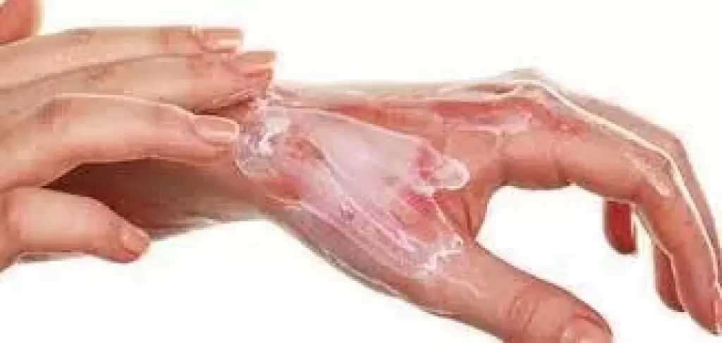 لا يُسبّب تشوهات | «الصحة»: مصر الأكثر إصابة بالحروق .. والتبرع بالجلد يكون بالطبقة السطحية